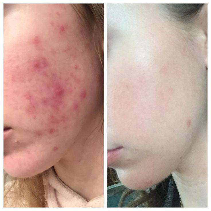 بالم ترمیم کننده پوست لاروش پوزای مدل CICAPLAST حجم 40 میل