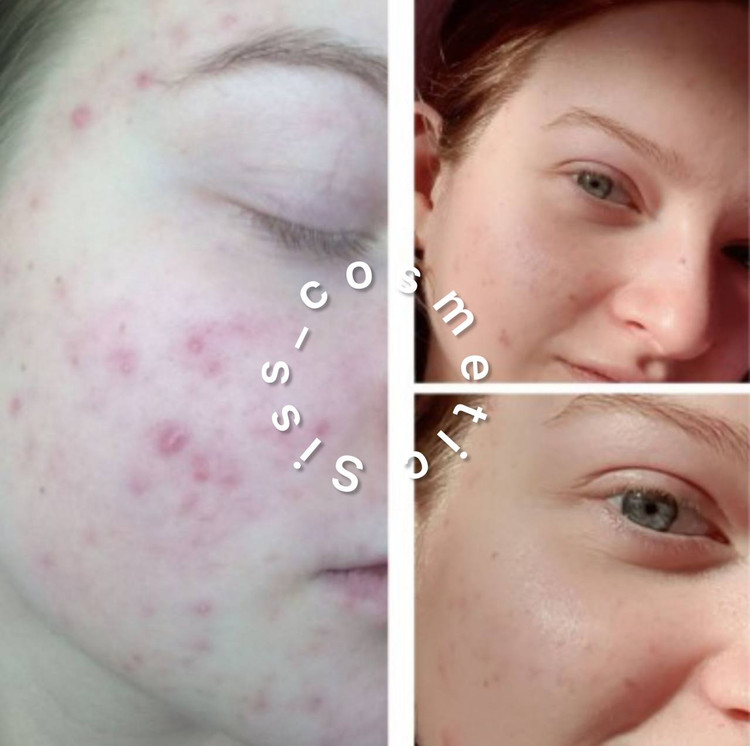 سرم نیاسینامید 10% + زینک 1% کاز دی باها حجم 60 میل