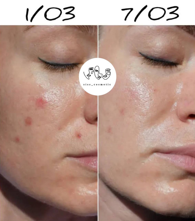 سرم ضدلک وروشن کننده نیاسینامید ۱۰ %(+ آلفا آربوتین ۲٪) تیام حجم ۴۰ میل