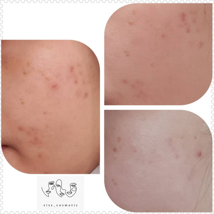 سرم ضدلک وروشن کننده نیاسینامید ۱۰ %(+ آلفا آربوتین ۲٪) تیام حجم ۴۰ میل